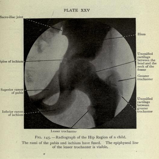 Radiograph of the Hip Region of a child