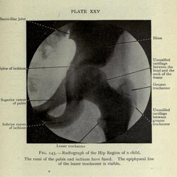Radiograph of the Hip Region of a child