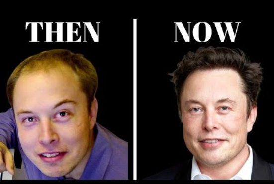Hair Transplant Surgeon Reacts to Elon Musk's Hair