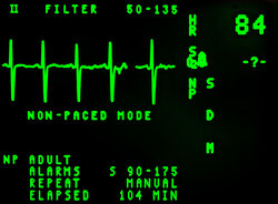 Heart beat rate on monitor