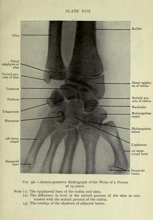 Antero-posterior Radiograph of the Wrist of a Person of 19 years